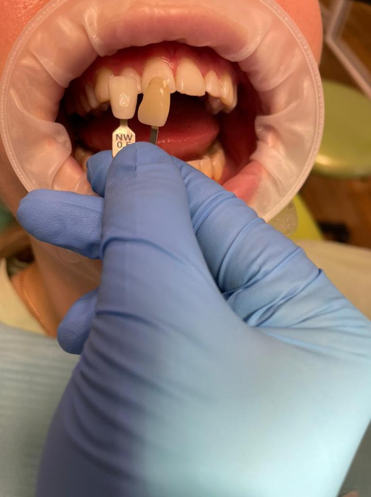 Результат - зубы на несколько оттенков белее чем было до отбеливания