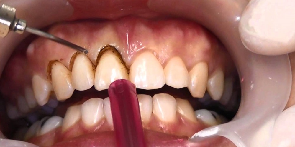 Контурирование зубов: когда прибегать к данной процедуре?
