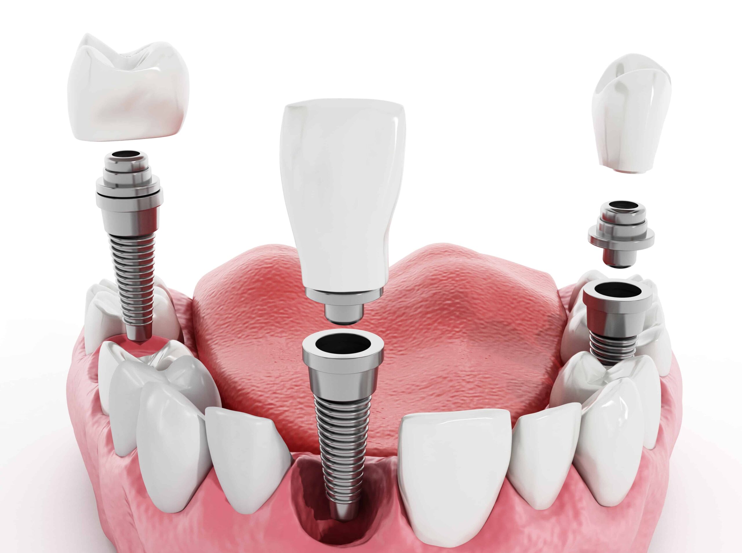 ICX Dental Implants абатмент