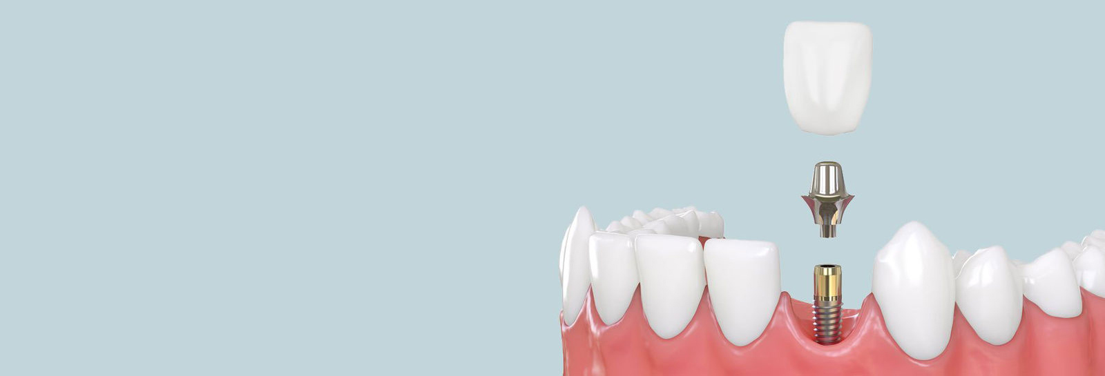 Коронка стоматология